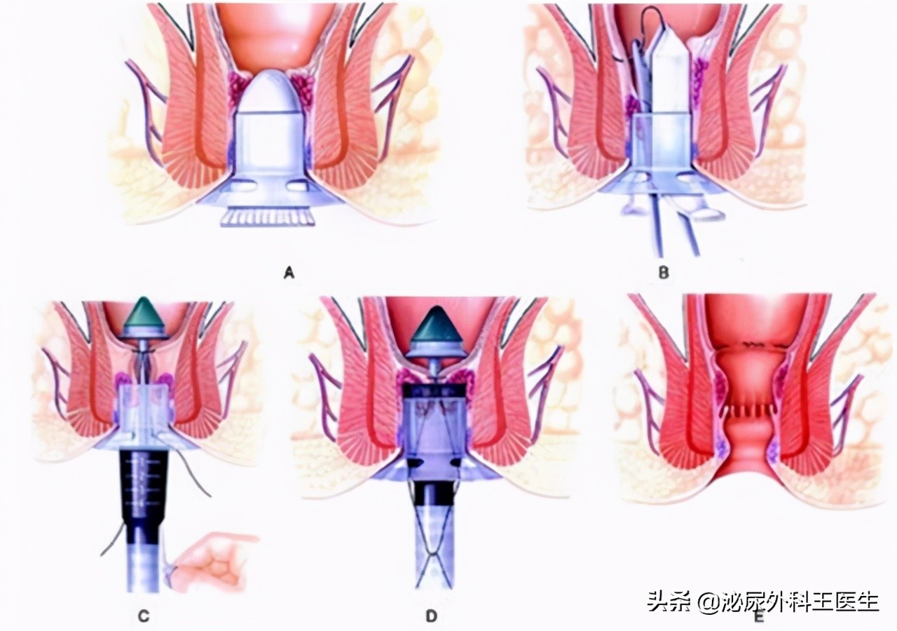 创新突破：揭秘痔疮治疗的尖端新方法